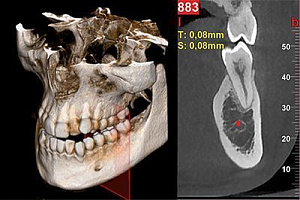 Стоматологический томограф NewTom 2D/3D GO (10x10) с цефалостатом - Фото 7