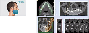 Стоматологический томограф NewTom 2D/3D GO (10x10) с цефалостатом - Фото 9